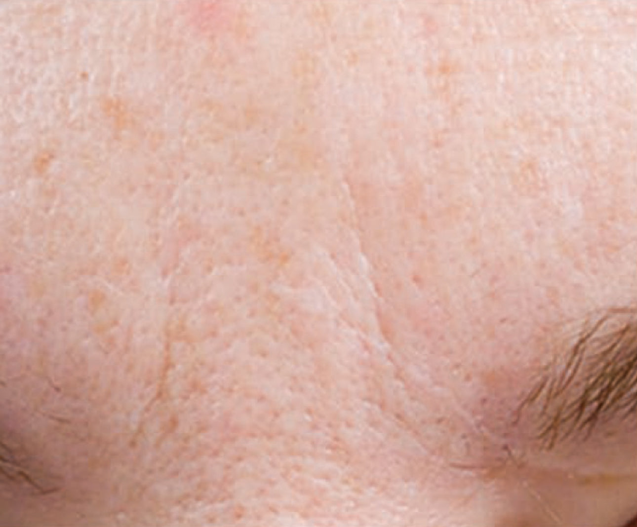 SUPER SERUM ADVANCE+® - Anti-Aging, Brightening, gegen Pickelmale, gegen Vernarbungen, Super-Antioxidant