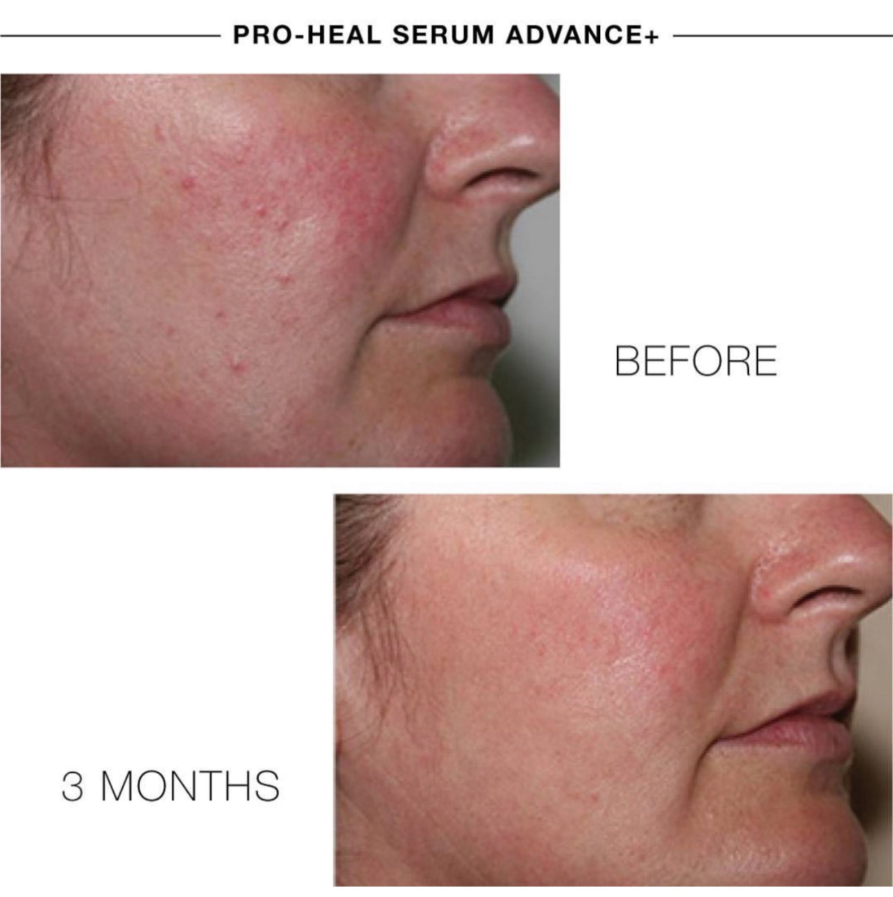 PRO-HEAL® SERUM ADVANCE+ - Heilend, reparativ, entzündungshemmend, gegen Rötungen