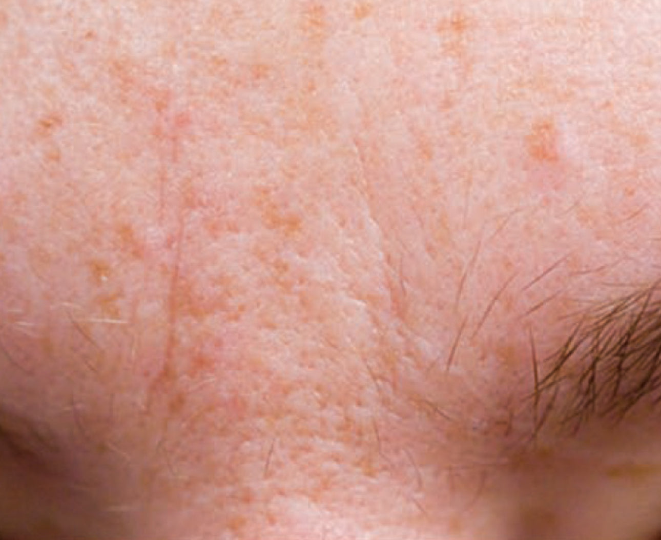 SUPER SERUM ADVANCE+® - Anti-Aging, Brightening, gegen Pickelmale, gegen Vernarbungen, Super-Antioxidant