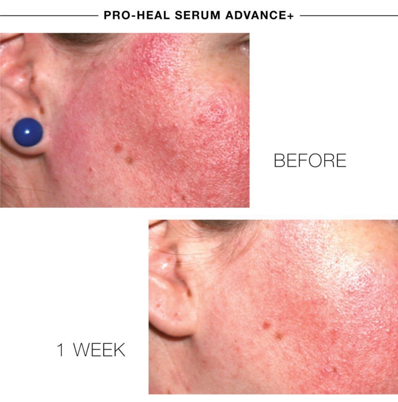 PRO-HEAL® SERUM ADVANCE+ - Heilend, reparativ, entzündungshemmend, gegen Rötungen