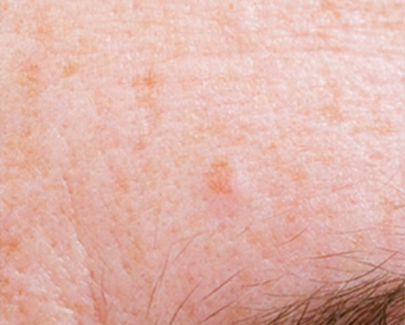 SUPER SERUM ADVANCE+® - Anti-Aging, Brightening, gegen Pickelmale, gegen Vernarbungen, Super-Antioxidant