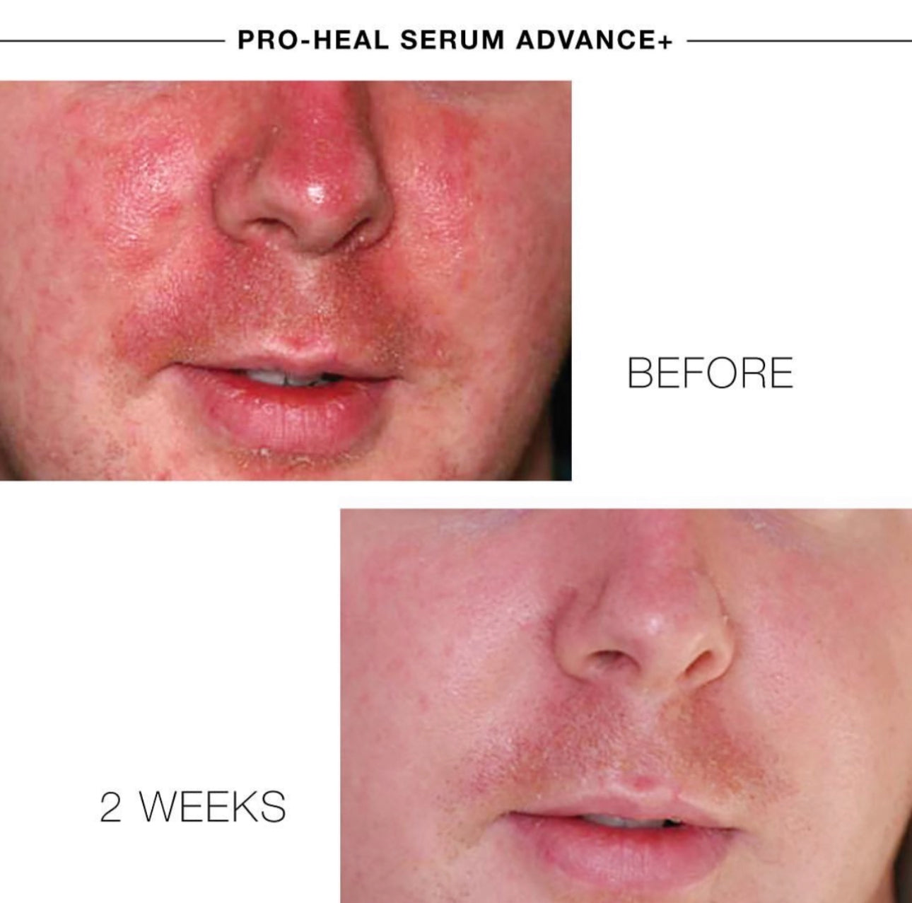 PRO-HEAL® SERUM ADVANCE+ - Heilend, reparativ, entzündungshemmend, gegen Rötungen